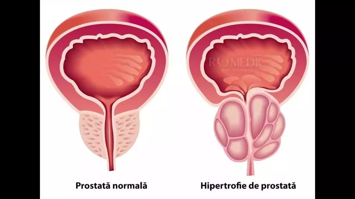 Vitaprost în Sibiu: cum să îmbunătățești sănătatea prostatei